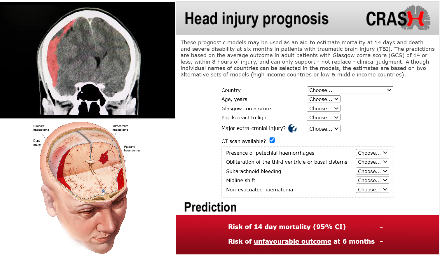 TBI calculator